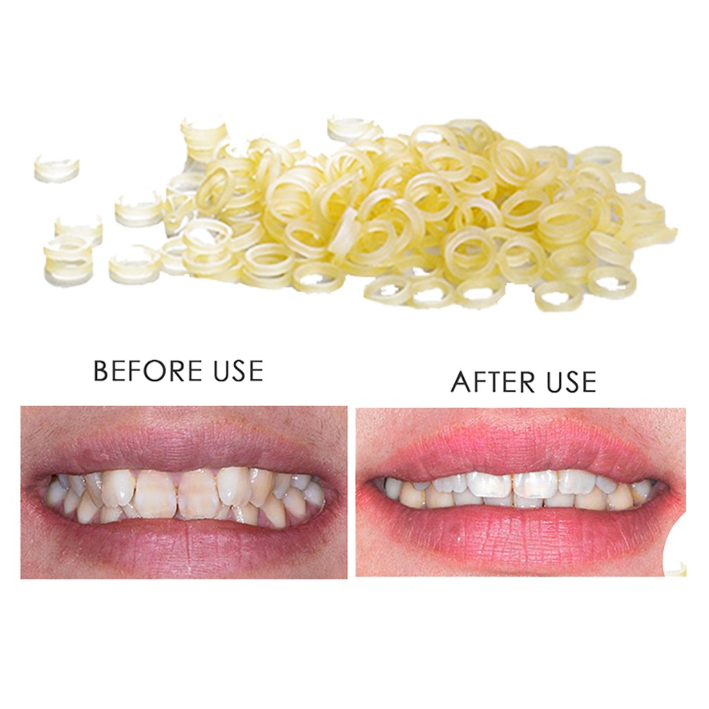 Reed 100 Pcs Dental Rubber Bands Orthodontic Elastics Braces Teeth Gap, Size: One Size